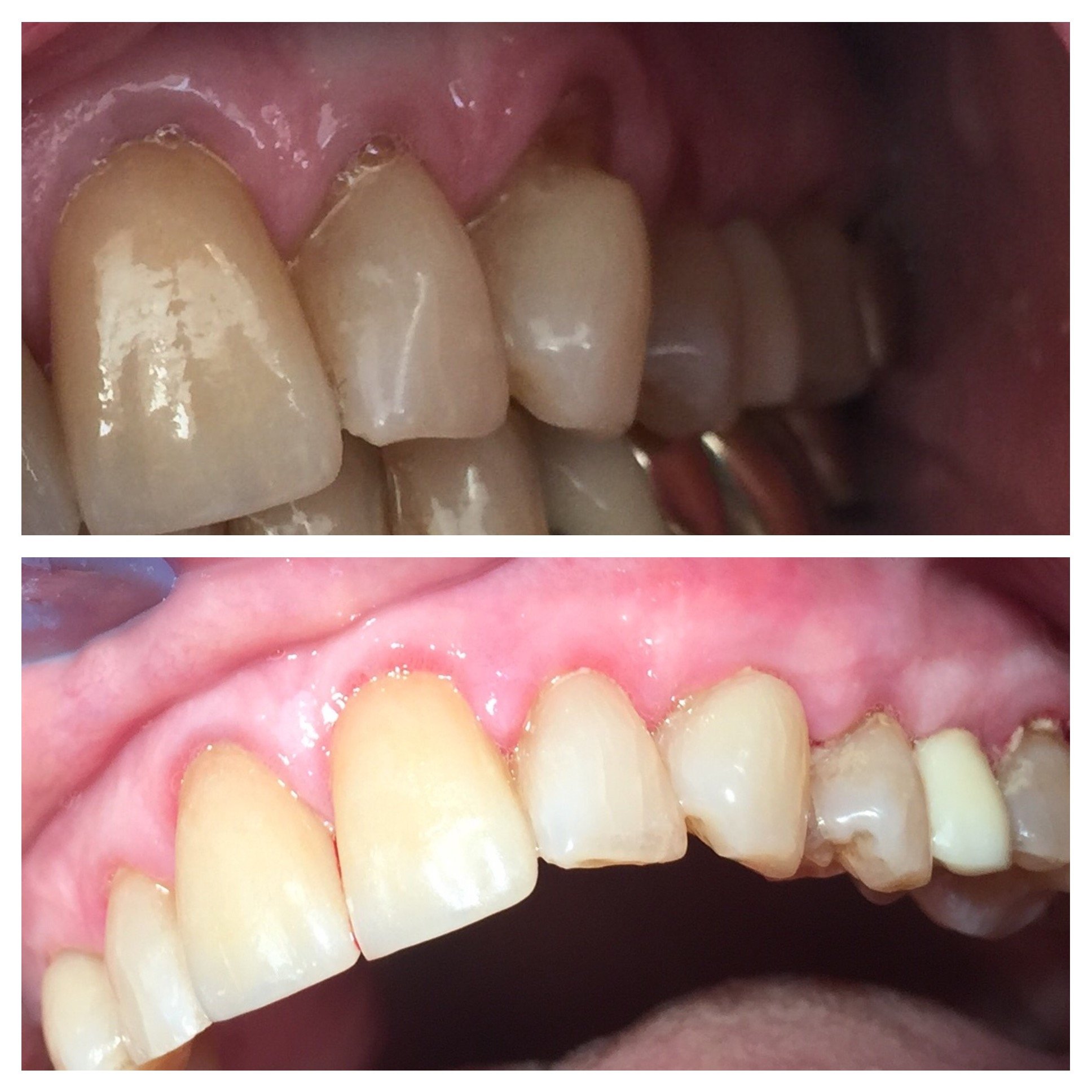 before and after