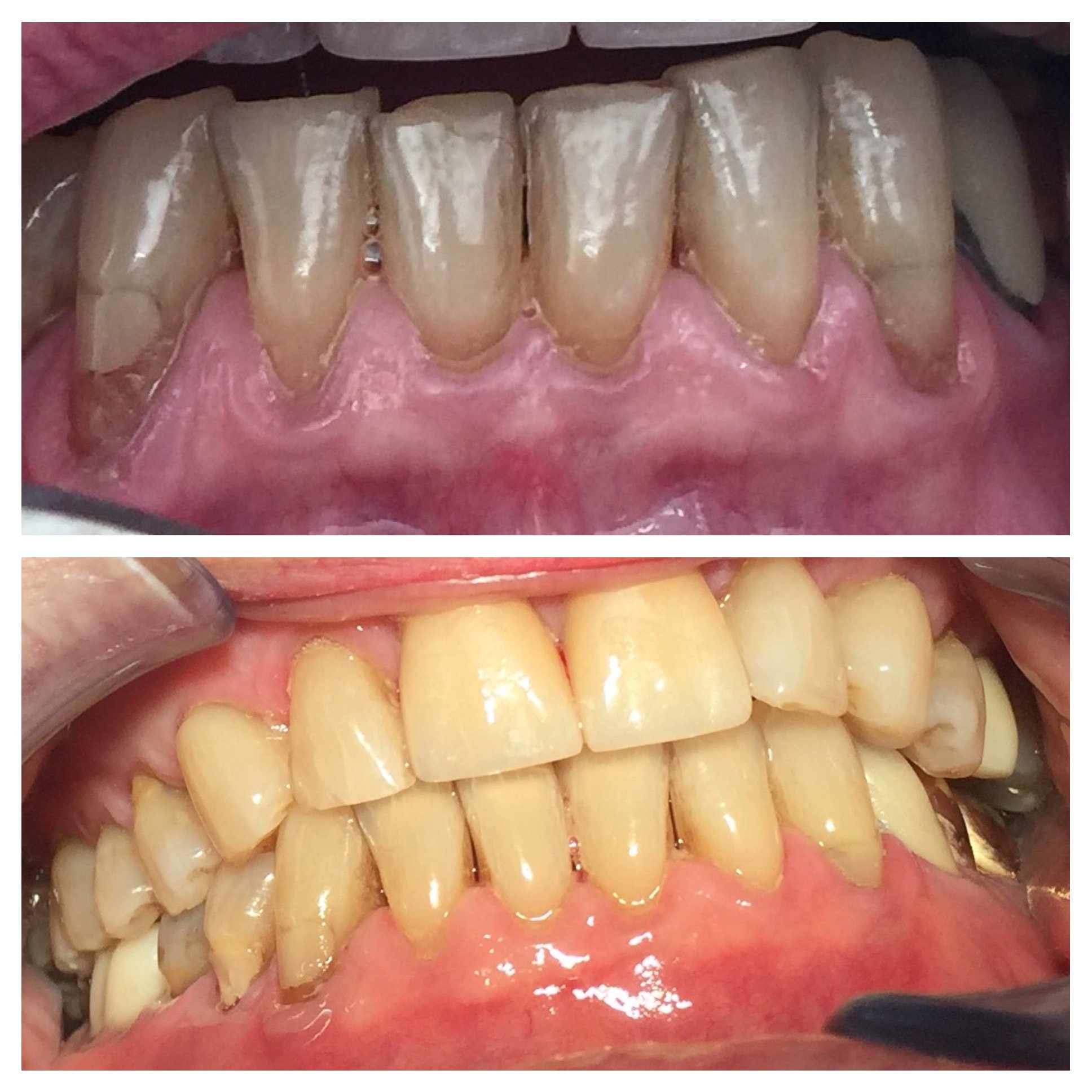 before and after