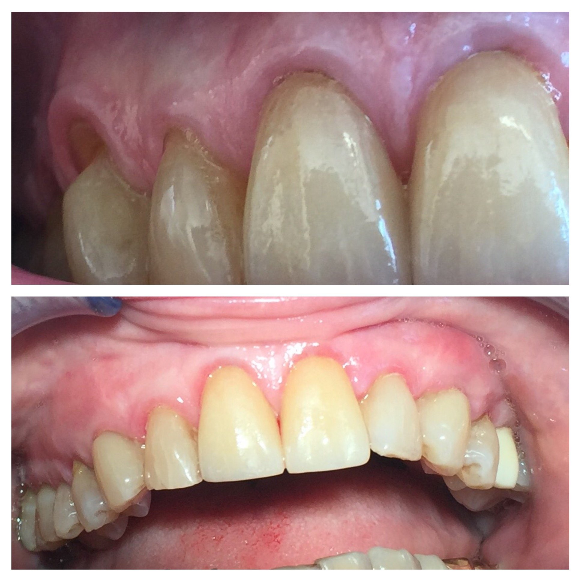 before and after
