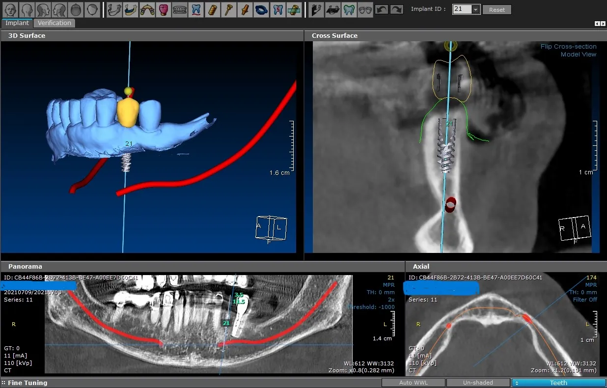 Implant Surgical Review004