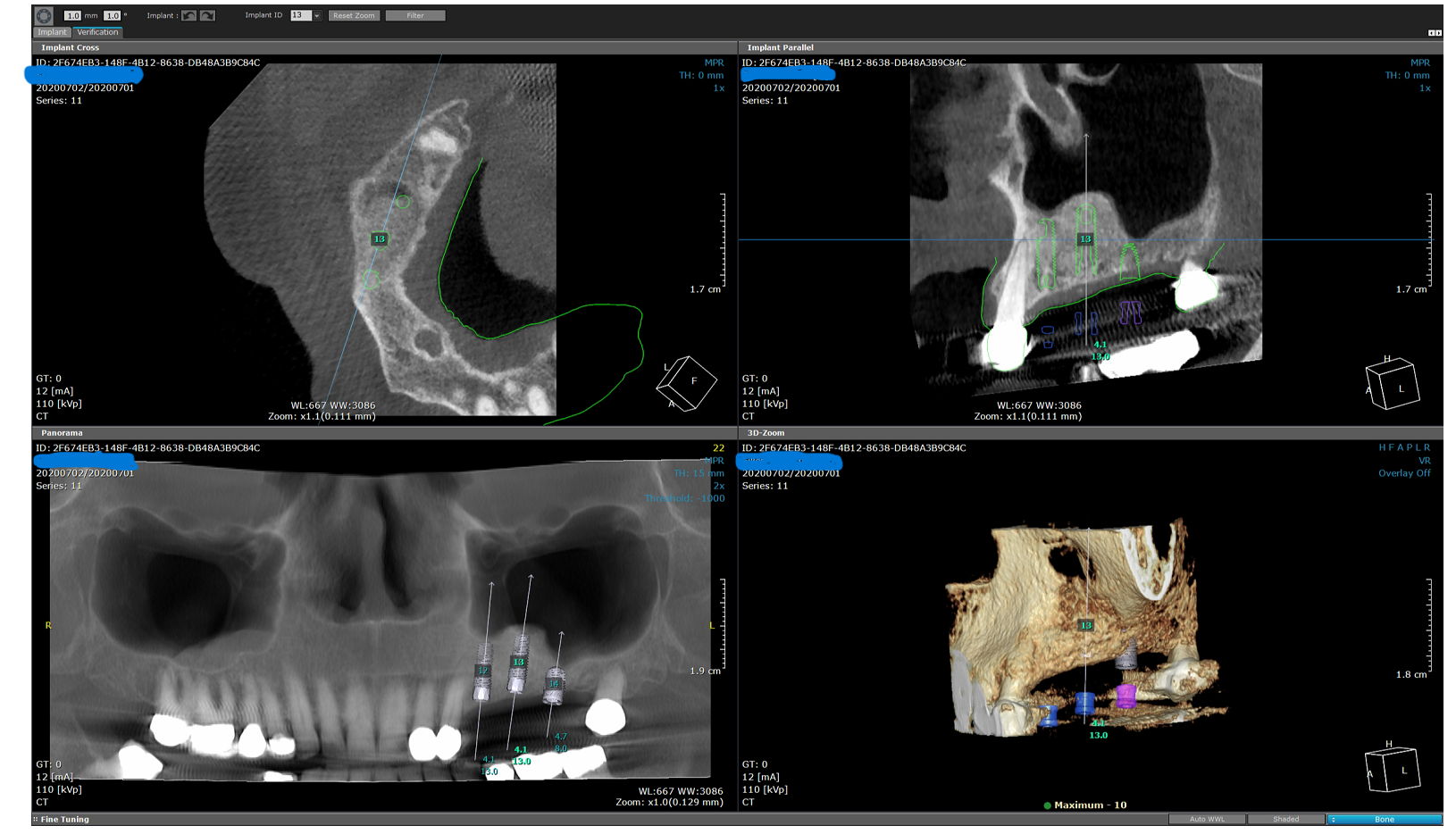 Implant Sx review5