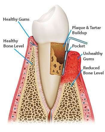 Periodontal-Disease